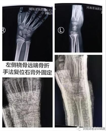 【安陽黃塔骨科醫院】9歲患者左橈骨遠端骨折+左側肱骨遠端粉碎性骨折病例分享