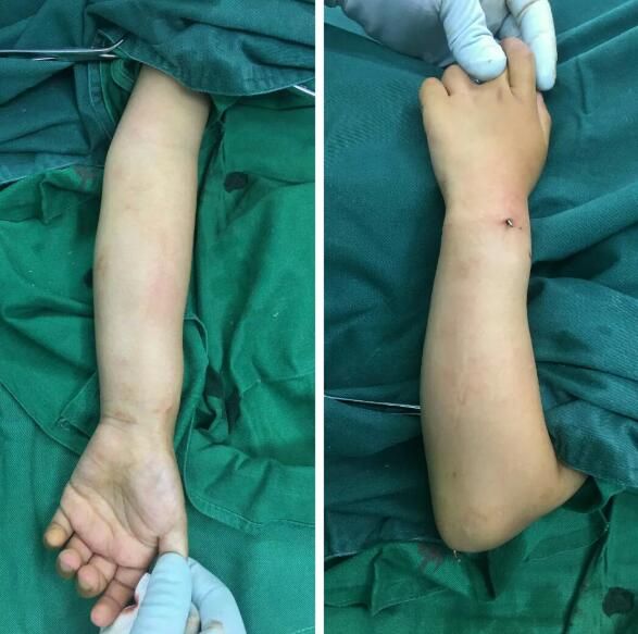 安陽黃塔骨科醫院骨一病區——兒童前臂骨折的急診微創手術